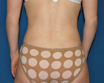 Liposuction of the Back and Abdomen