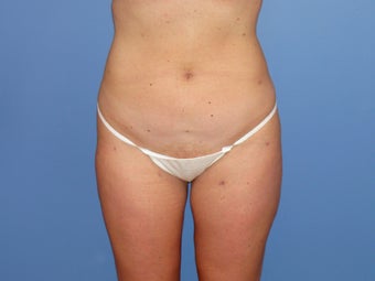 Tumescent liposuction before and after