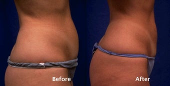 Tummy liposuction