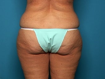 Liposuction after Age 50