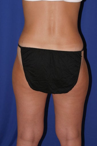 Liposuction