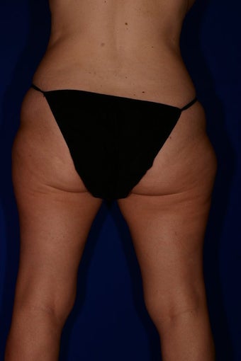 Liposuction