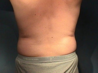 Liposuction