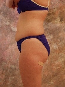 Liposuction