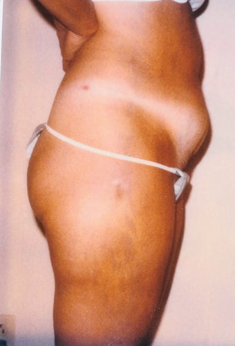 Liposuction