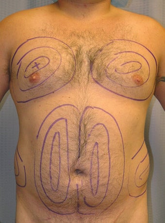 Tumescent liposuction