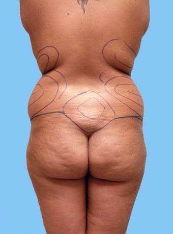 Liposuction