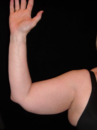 Liposuction of upper arm
