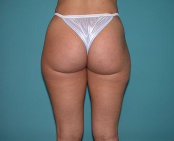 Liposuction of flanks and outer thighs