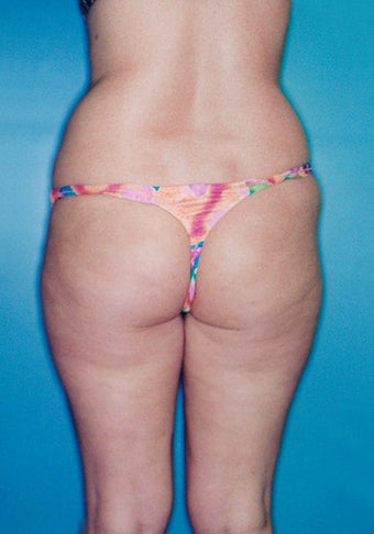 Power Assisted Liposuction (Hips, Thighs, Stomach & Back)