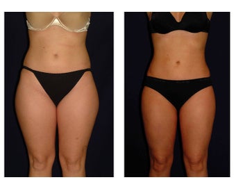 Liposuction