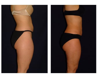 Liposuction