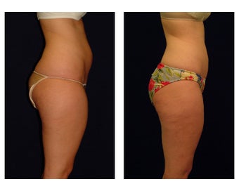 Liposuction