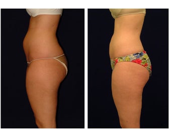 Liposuction