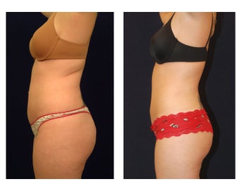 Liposuction