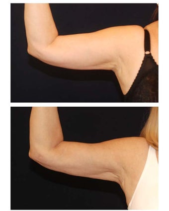 Liposuction