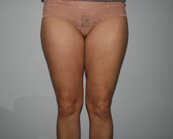 Liposuction of the Hips and Thighs