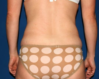 Liposuction of the Back and Abdomen