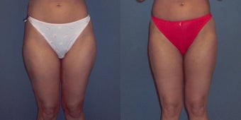Tumescent Liposuction