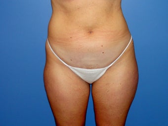 Tumescent liposuction before and after