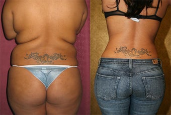 Tumescent Liposuction