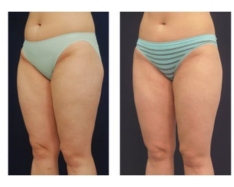 Liposuction