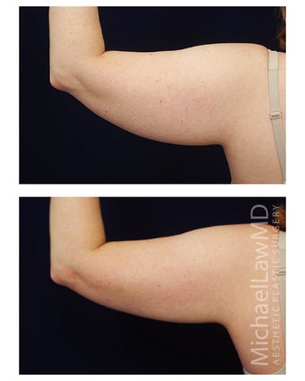 Liposuction