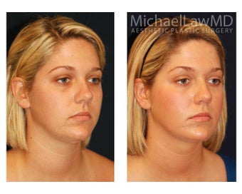 Chin Liposuction