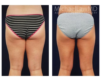 Liposuction