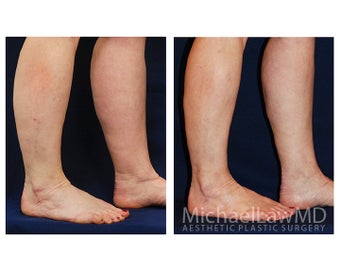 Liposuction