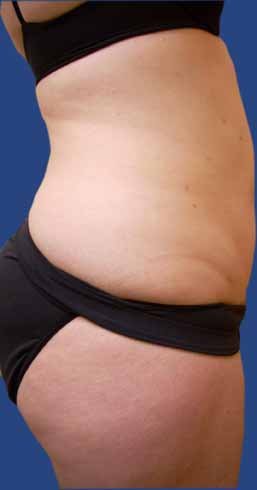 Abdomen Liposuction