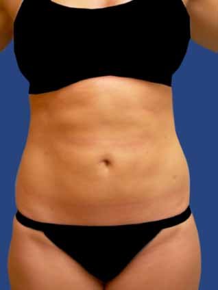 Abdomen Liposuction