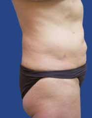 Abdomen Liposuction