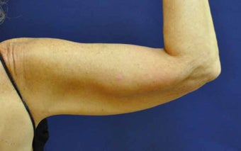 Liposuction Upper Arm