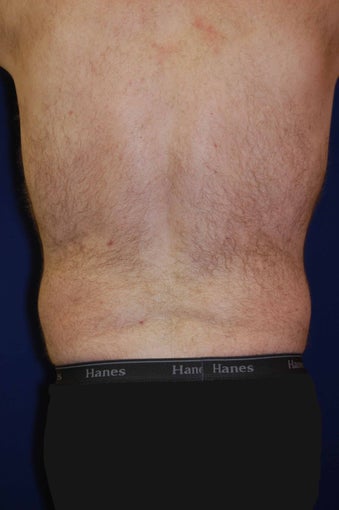 Liposuction of Waist