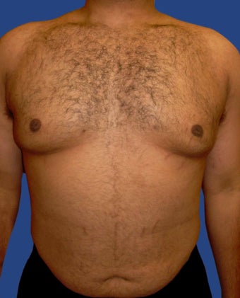 Male Breast Reduction