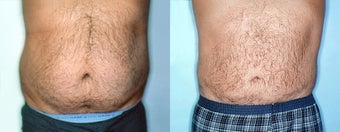 Male Stomach & Love Handles Lipo