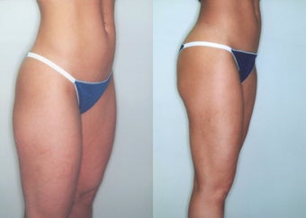 Liposuction (Thighs, Knees & Buttocks)