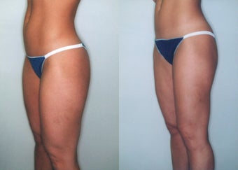 Liposuction (Thighs, Knees & Buttocks)