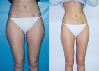Liposuction of Posterolateral/Medial Thigh ('Saddlebags')