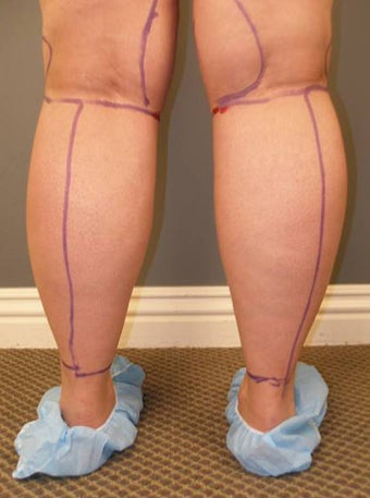 Tumescent Liposuction Under Local Anesthesia.