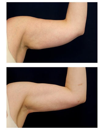 Liposuction