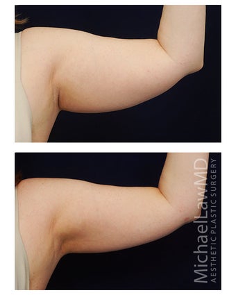 Liposuction