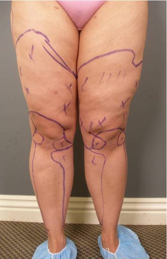 Tumescent Liposuction under local anesthesia.