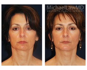Chin Liposuction