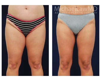 Liposuction