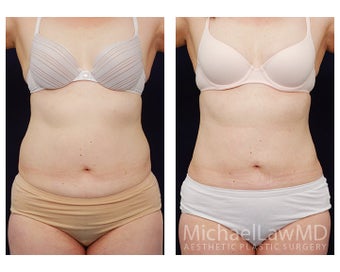 Liposuction