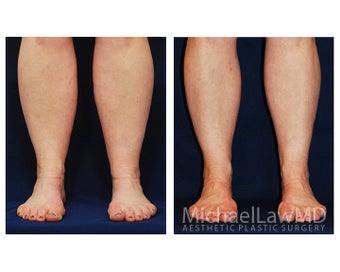 Liposuction
