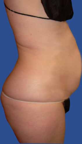 Abdomen Liposuction