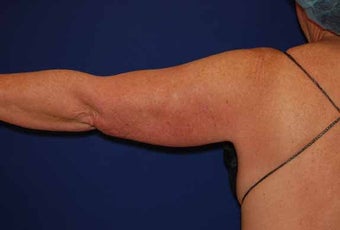 Liposuction Upper Arm